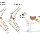 The Common ACL Tear: What NOT to Do!